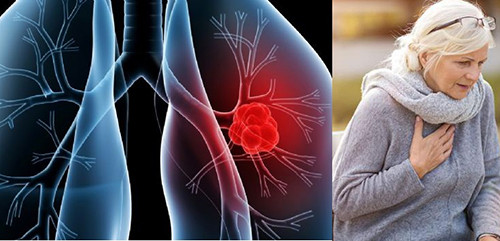 İlçe sağlık müdürlüğünden, Pulmoner hastalığı açıklaması 